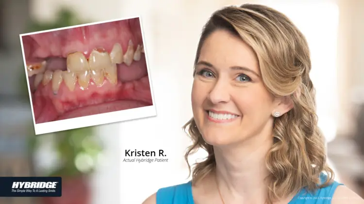 Hybridge before and after woman smile