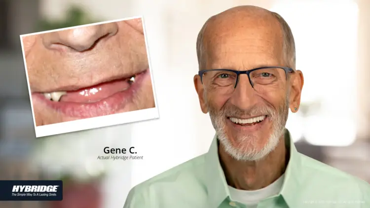 hybridge before and after man's smile
