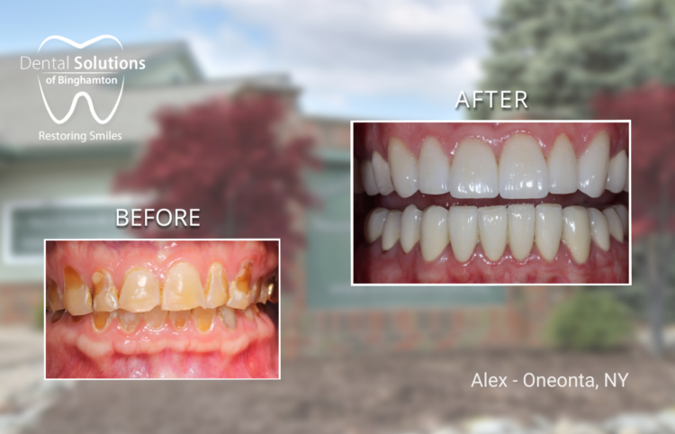 Dental Crowns Binghamton, NY