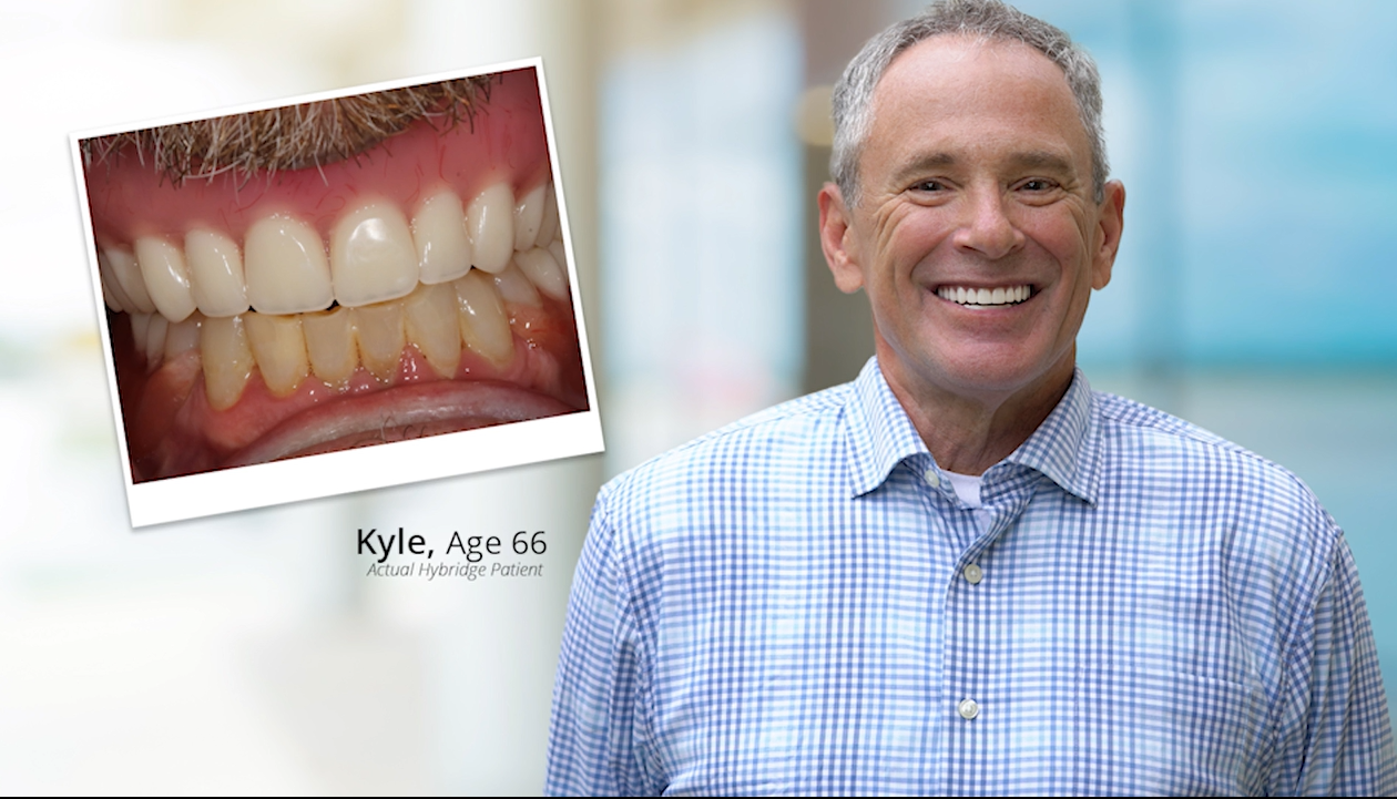 Hybridge Dental Implants